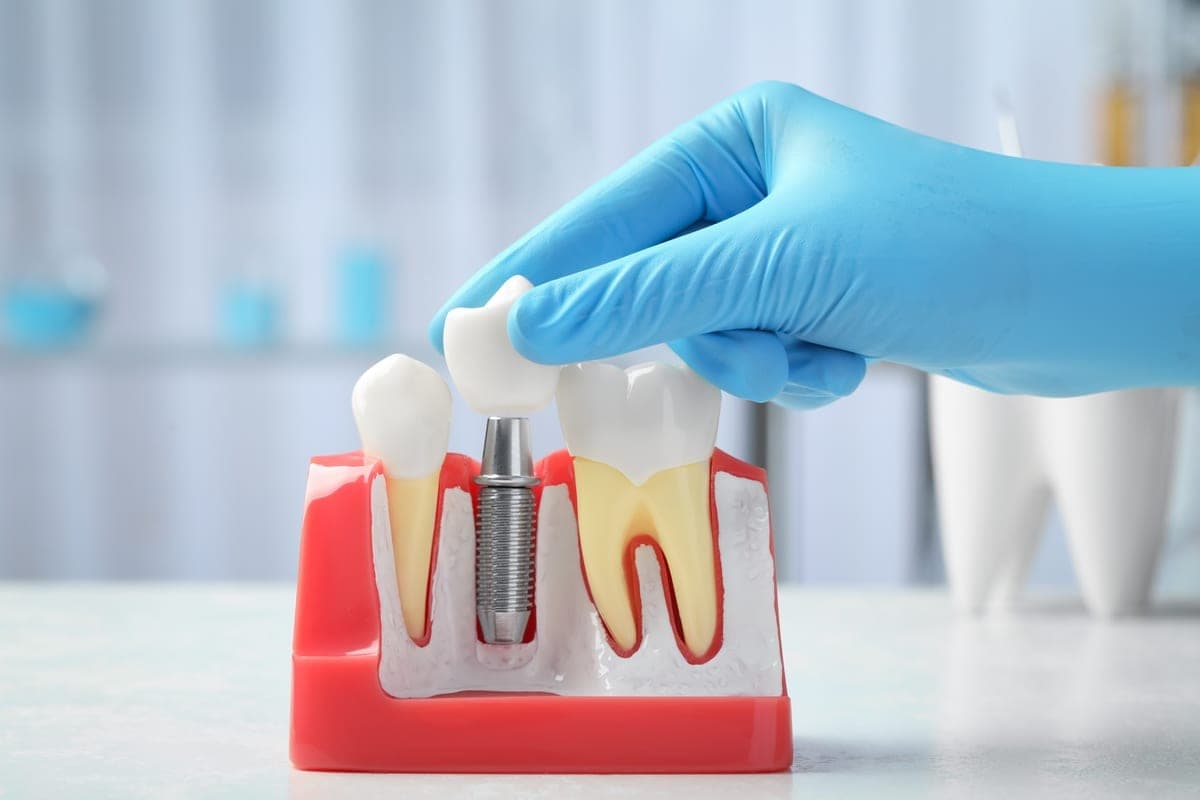 Dental crowns in Clearwater: comparing porcelain, zirconia and metal crown materials