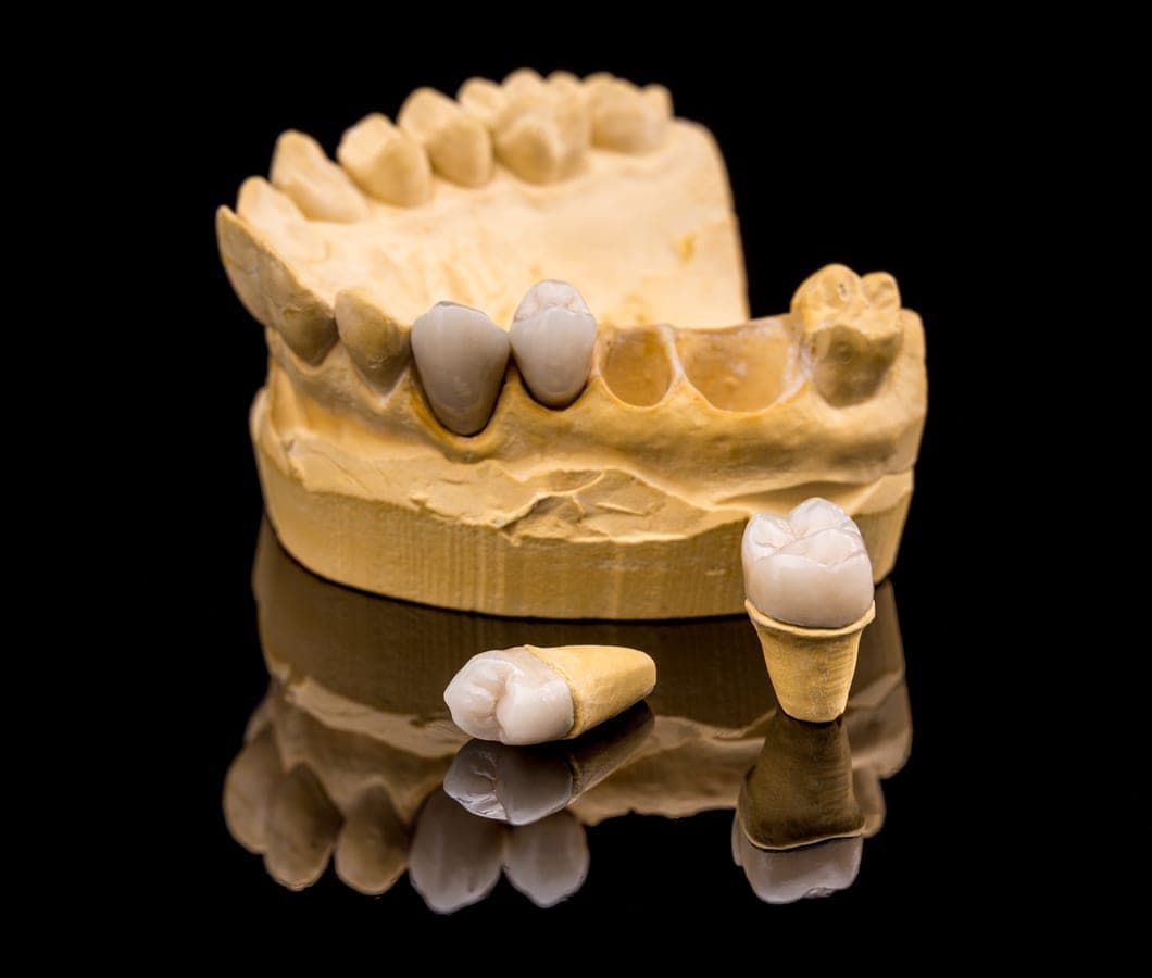Dentist explaining the process for dental crowns in Clearwater to a patient