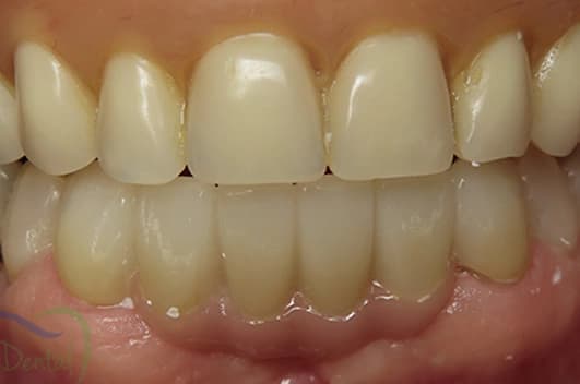 Smile restoration — after treatment