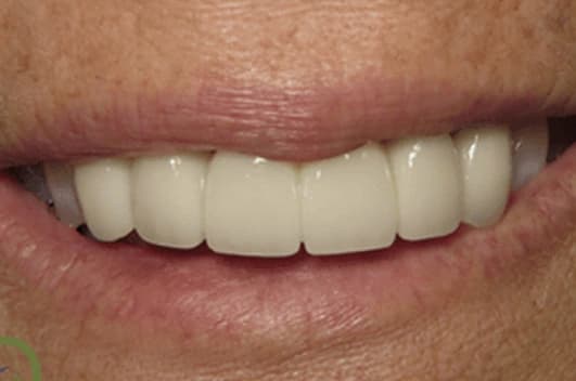 Smile restoration — after treatment