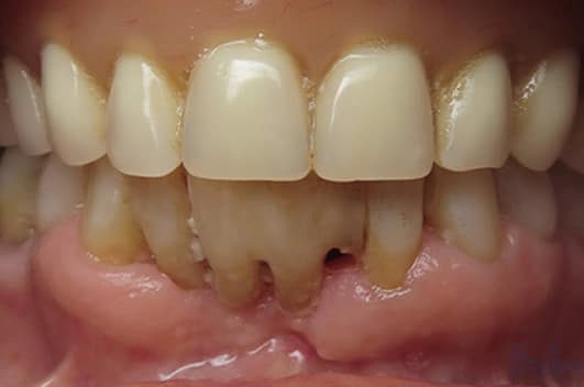 Smile restoration — before treatment