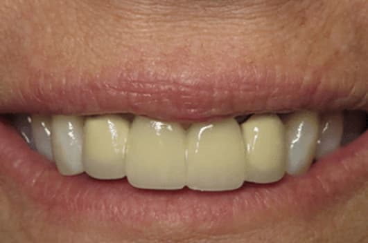 Smile restoration — before treatment