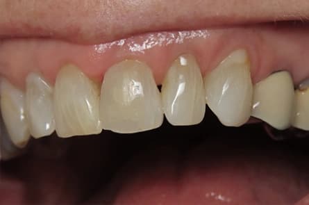 Tooth-colored fillings — after treatment