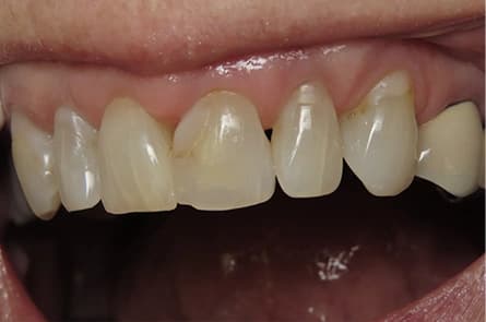 Tooth-colored fillings — before treatment