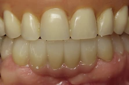 Dental bridge — after treatment