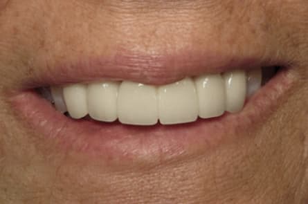 Dental bridge — after treatment