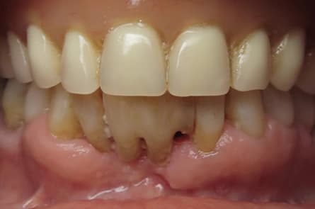 Dental bridge — before treatment