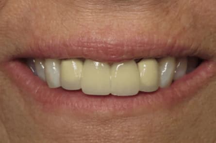 Dental bridge — before treatment