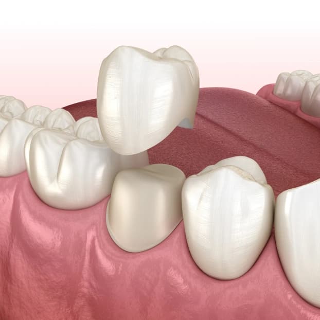 Natural-looking porcelain dental crowns in Clearwater, FL at Boulevard Dental