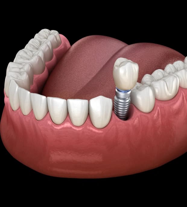 Natural-looking smile restored with dental implants in Clearwater, FL