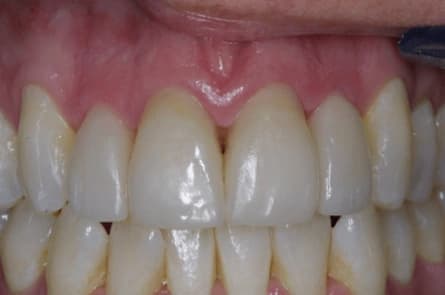 Smile makeover — after treatment