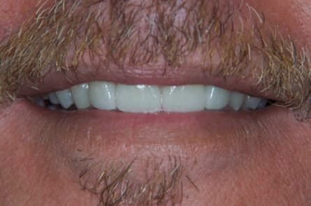 Smile makeover — after treatment