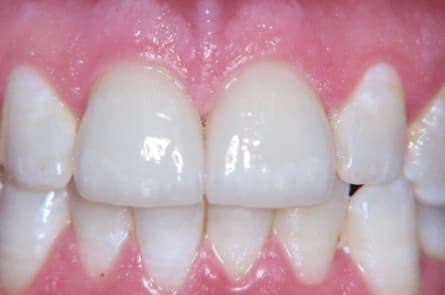 Smile makeover — after treatment