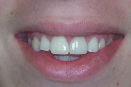 Smile makeover — after treatment