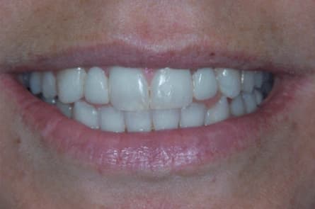 Smile makeover — after treatment