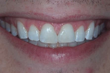 Smile makeover — after treatment