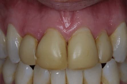 Smile makeover — before treatment