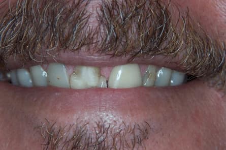 Smile makeover — before treatment