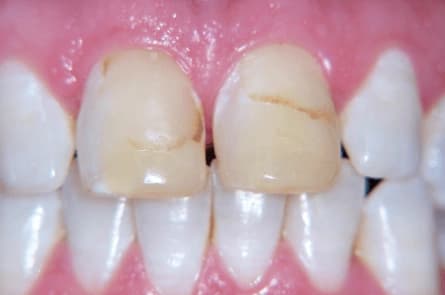 Smile makeover — before treatment
