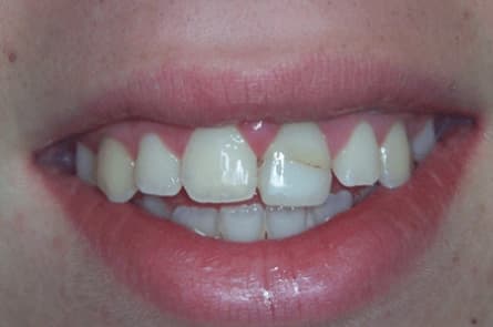 Smile makeover — before treatment