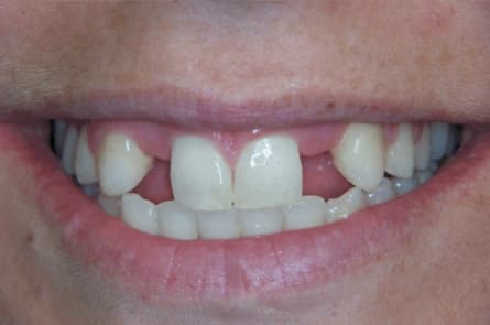 Smile makeover — before treatment