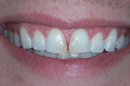 Smile makeover — before treatment