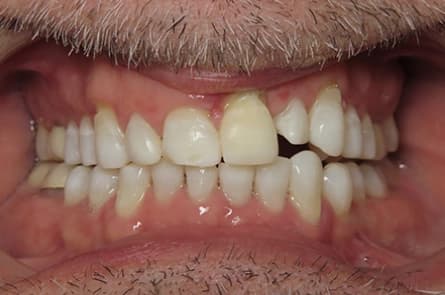 Teeth whitening — after treatment