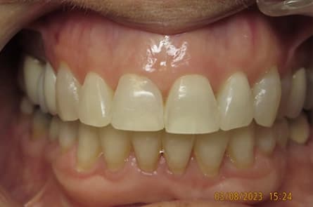 Teeth whitening — after treatment