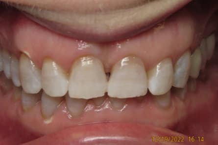 Teeth whitening — after treatment