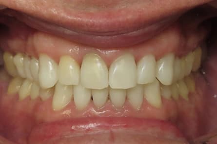 Teeth whitening — after treatment