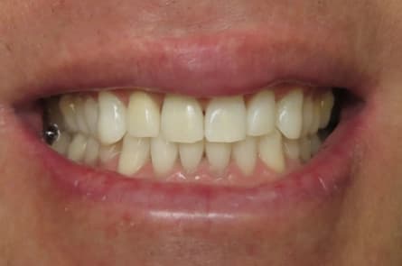 Teeth whitening — after treatment