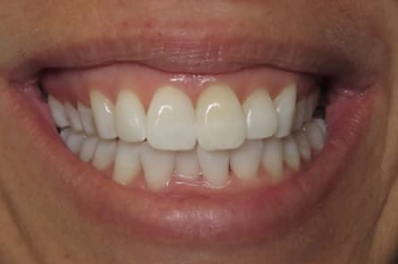 Teeth whitening — after treatment