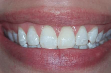 Teeth whitening — after treatment