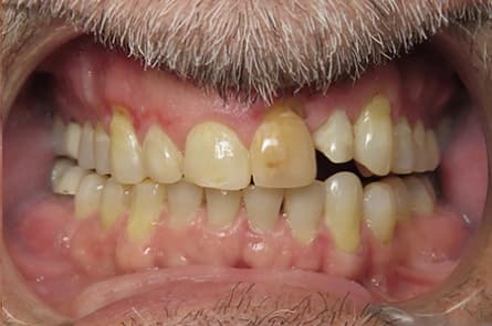 Teeth whitening — before treatment