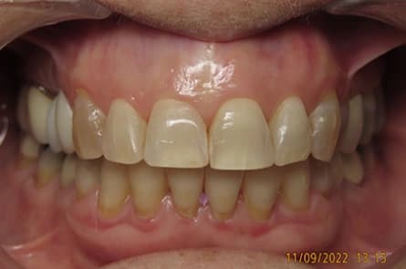 Teeth whitening — before treatment