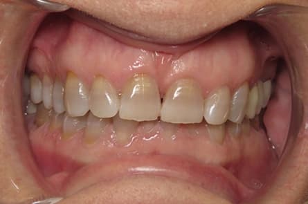Teeth whitening — before treatment