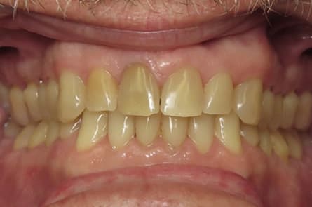 Teeth whitening — before treatment