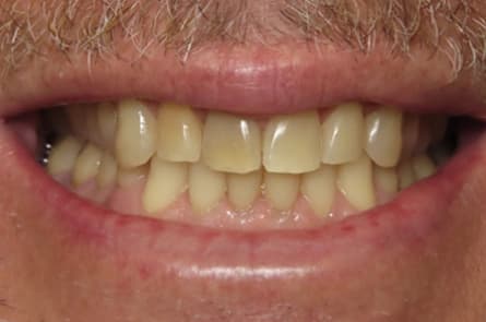 Teeth whitening — before treatment