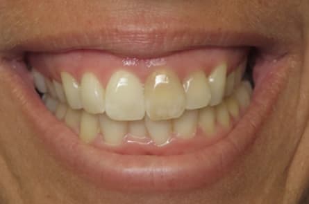 Teeth whitening — before treatment